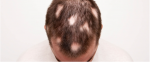 perte cheveux circulaire,alopecie areate,chute cheveux circulaire